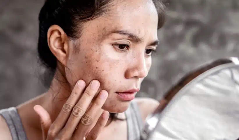 Hyperpigmentation et taches noires sur la peau